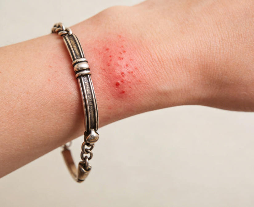 Skin irritation caused by nickel in cheap fashion jewelry